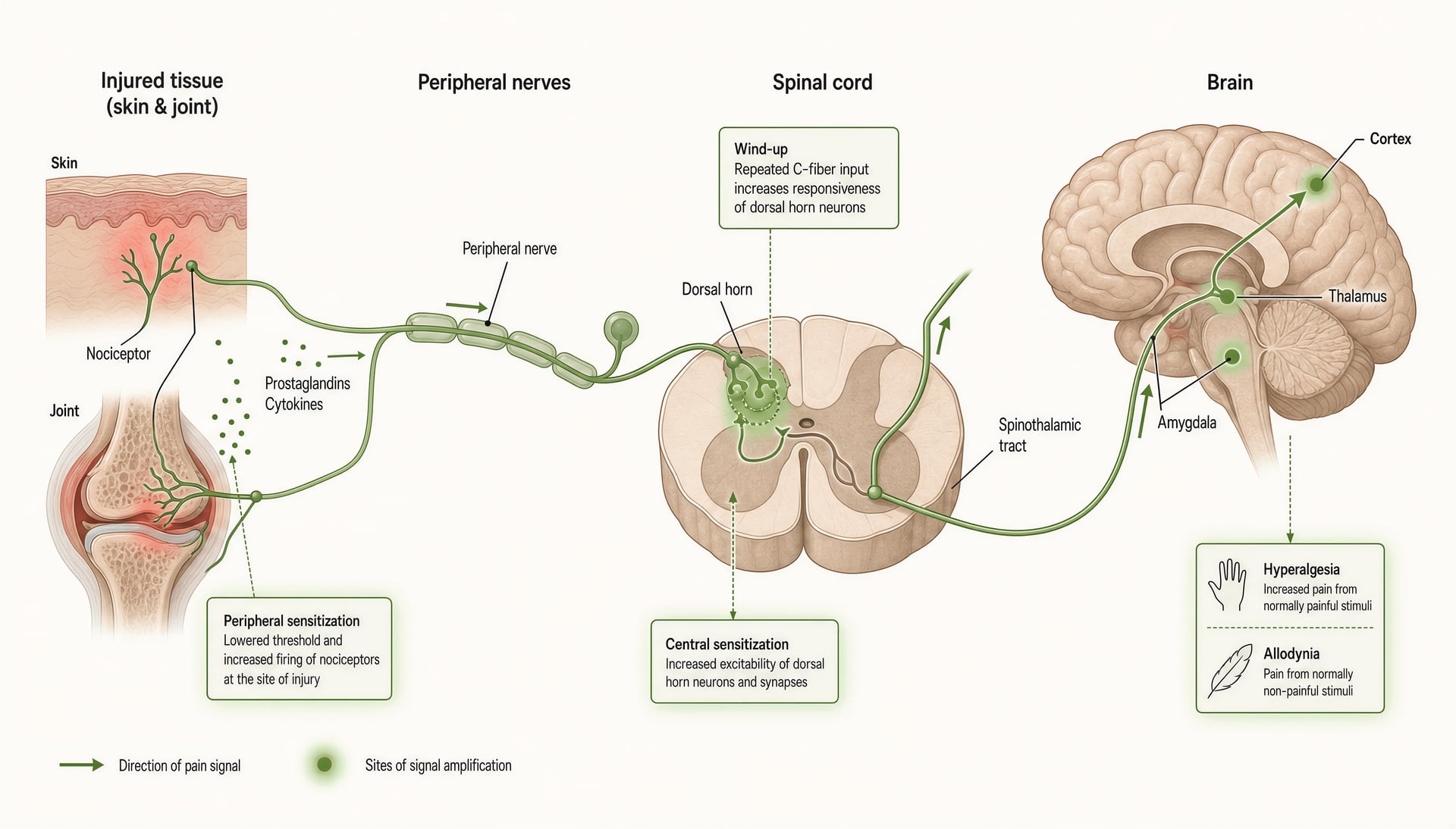 Diagram of pain signaling from nociceptors through the spinal cord to the brain, showing sensitization points.