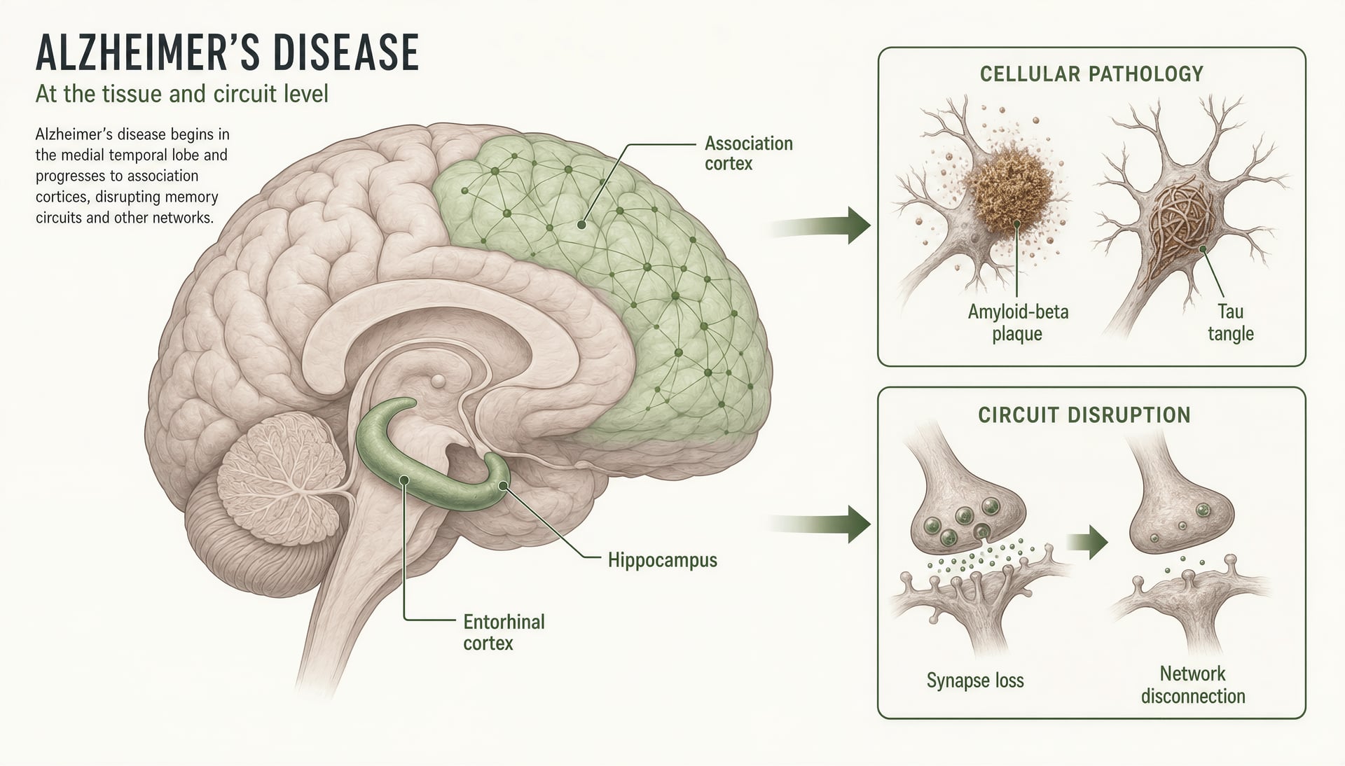Diagram of Alzheimer’s brain regions and the key lesions of amyloid plaques, tau tangles, and synapse loss.